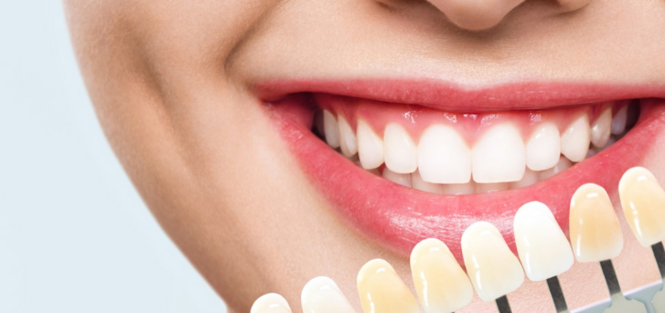 remedios para los dientes amarillos. Clínica dental en Avilés