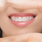 Luz Dental. Nunca es tarde para ponerse ortodoncia para adultos