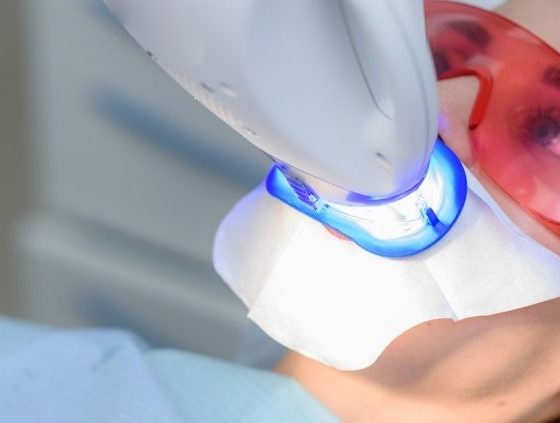 ¿Cómo funciona el blanqueamiento dental?. Luz Dental, dentistas en Avilés